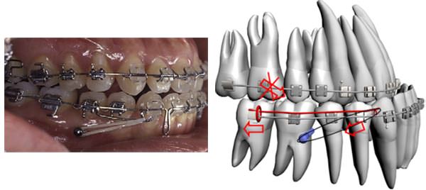 Fig.7 Tomado de Chung K-R, Kim S-H, Choo H, Kook Y-A, Cope JB. Distalization of the mandibular dentition with mini-implants to correct a Class III malocclusion with a midline deviation