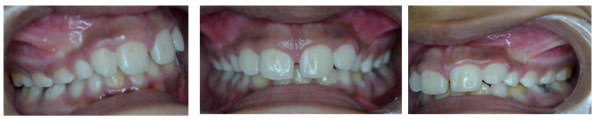 Figura 8 Alineador Dental
