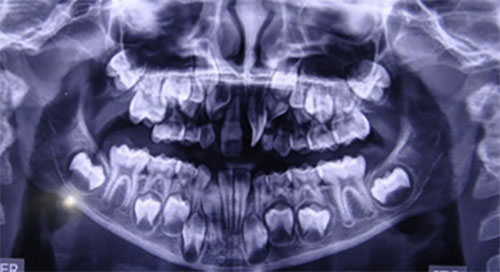 Figura 4 Radiografía Panorámica Inicial