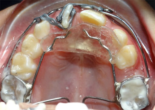 Figura 6 Fotografías Oclusal Arco transpalanance