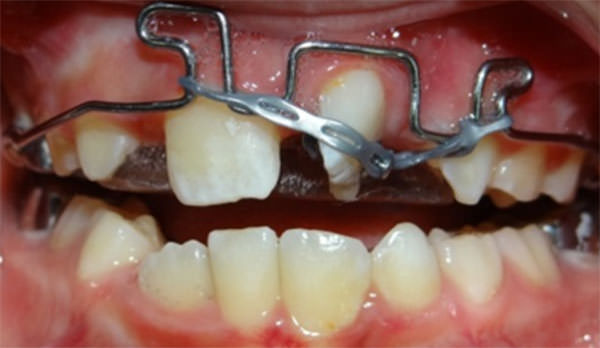 Figura 7 Sustema de Cupla con dobleces ansas. Botones cementados y cadenas elastoméricas de tracción