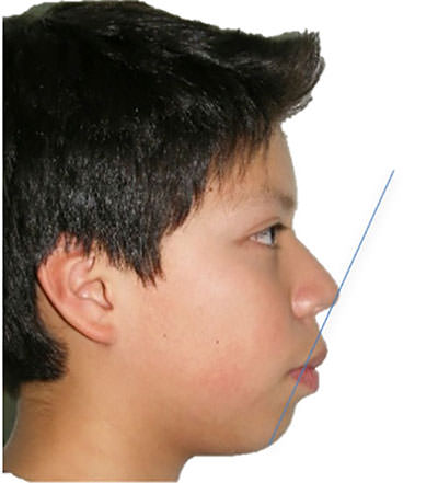 Fig. 2 Fotografía de perfil