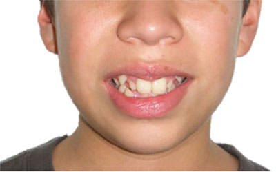 Fig. 4 Sonrisa