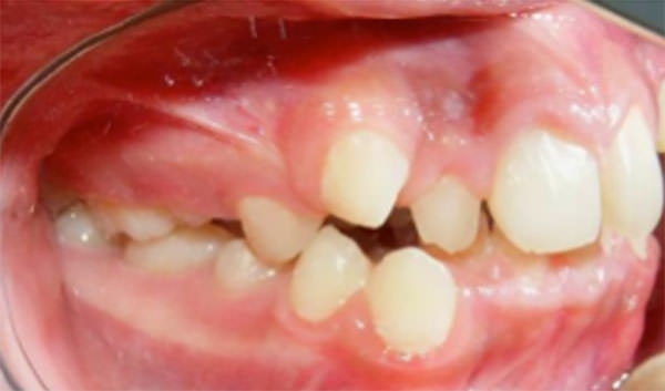 Fig. 5 Intraoral lateral derecha