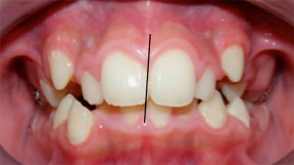Fig. 7 Lineas medias desviadas