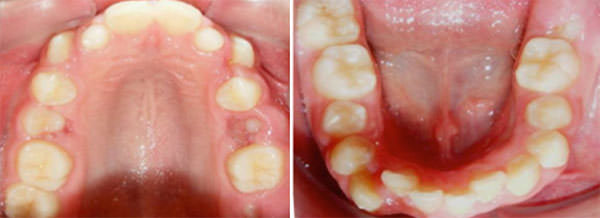 Fig. 8 Oclusales superior e inferior, formas de arco cuadradas