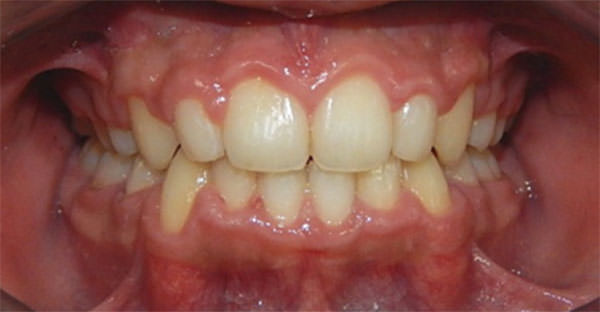 Fig. 14 Overjet y overbite adecuados, líneas medias coincidentes