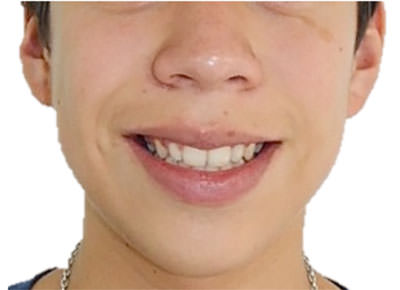 Fig. 16 Sonrisa