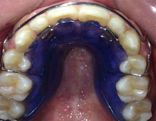 Fig. 18 Retenedor circunferencial