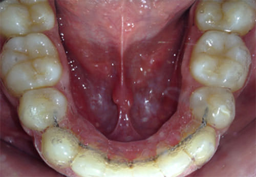 Fig. 19 Termoformado y fijo de 35 a 45