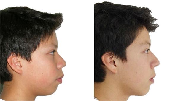 Fig. 20 Perfil al inicio y final del tratamiento.
