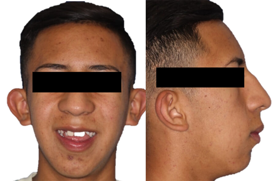 Fig.1 Extraoral frente sonrisa, perfil inicio