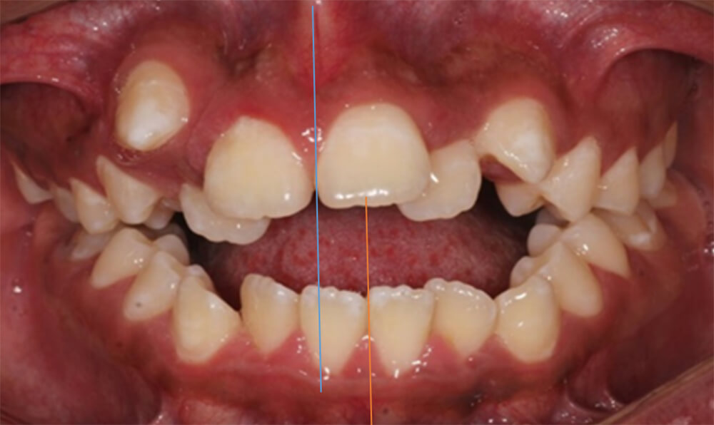 Fig.2 Intraoral de frente inicio
