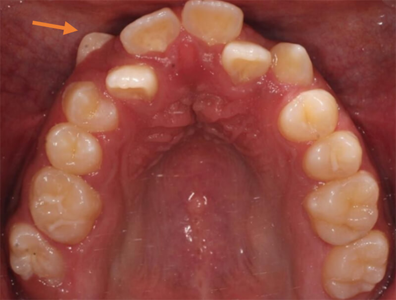 Fig.3 Intraoral vista oclusal superior