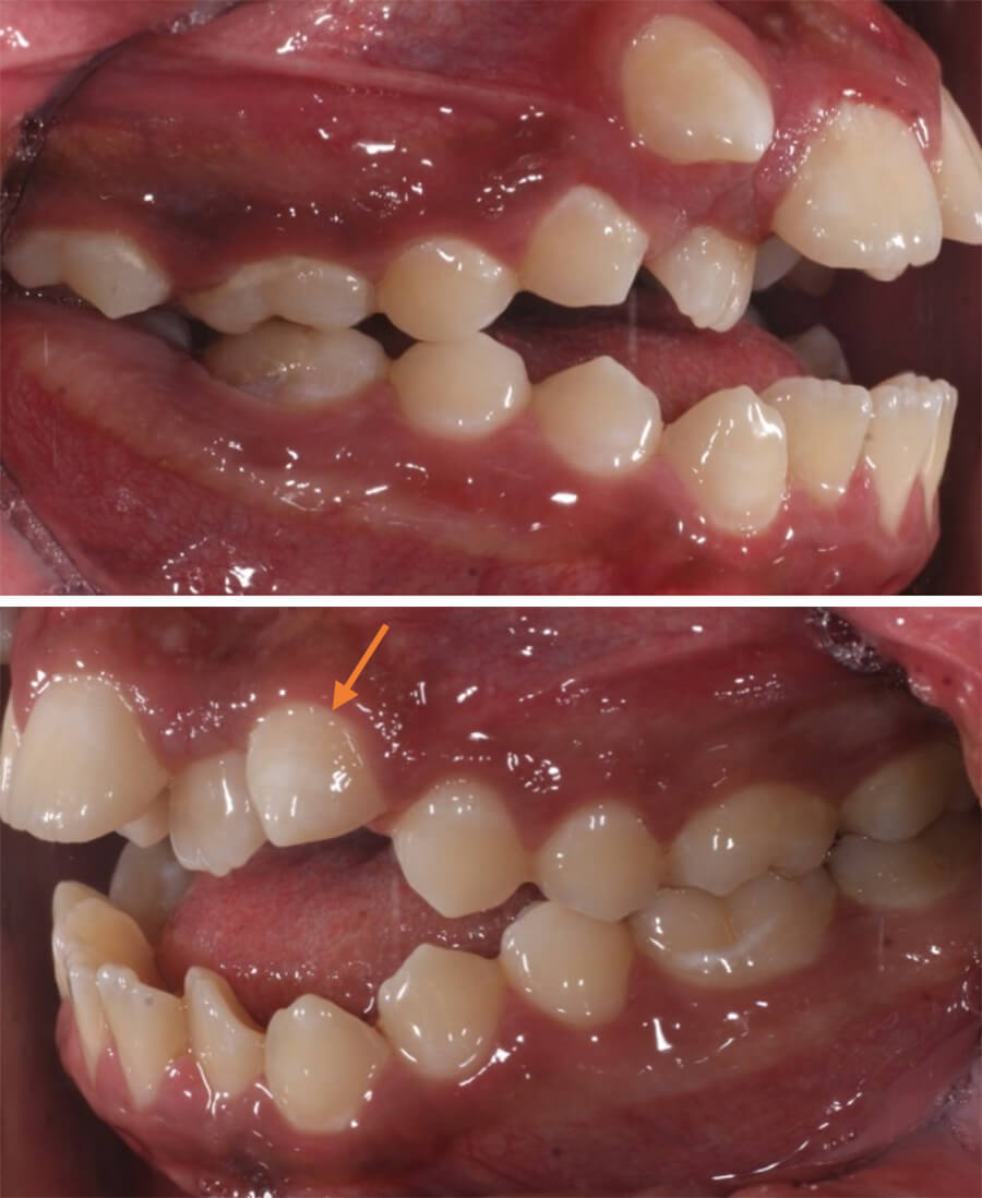 Fig.4 Intraoral lateral inicio derecha e izquierda