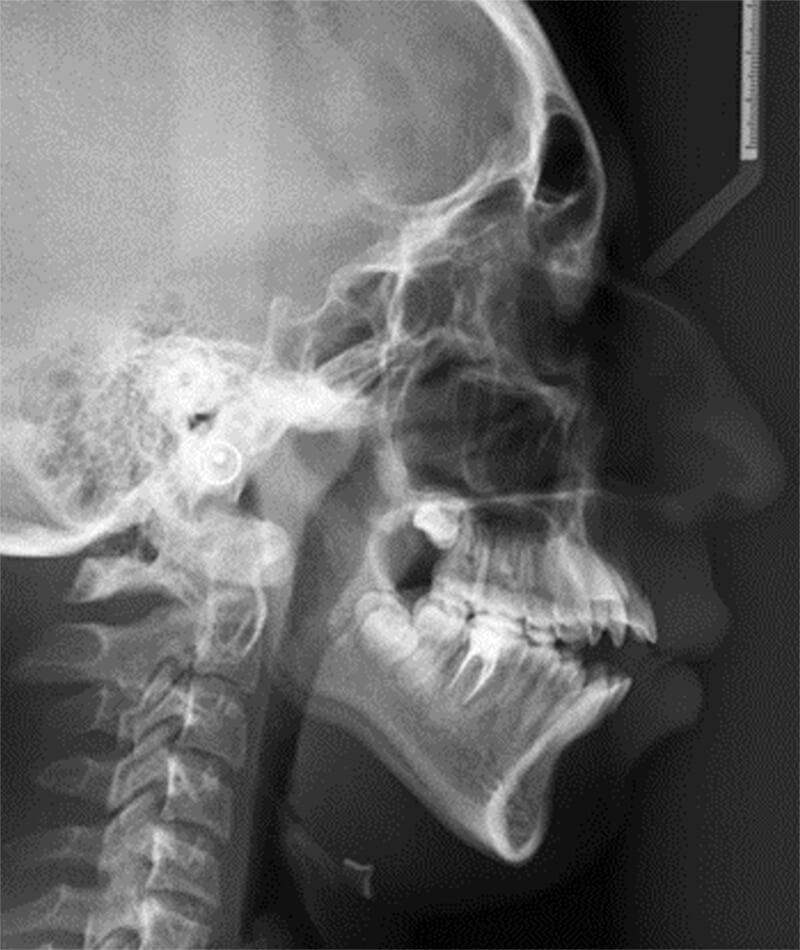 Fig.5 Radiografía lateral de cráneo inicio
