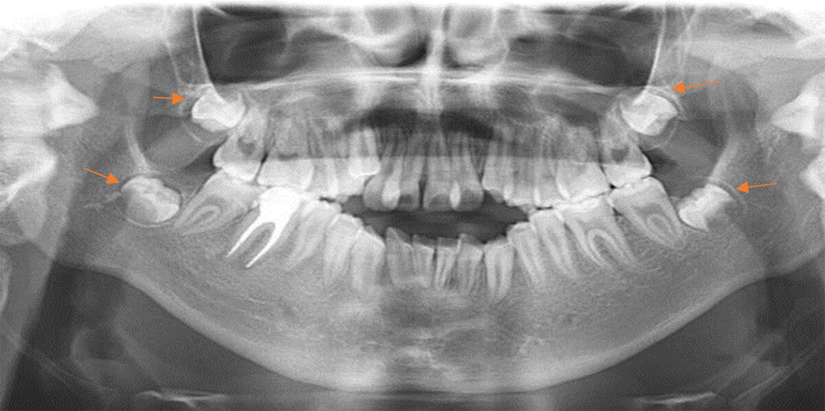 Fig.6 Radiografía panorámica inicio