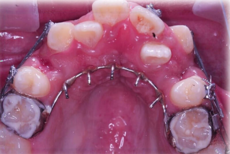 Fig. 7 Intraoral oclusal progreso