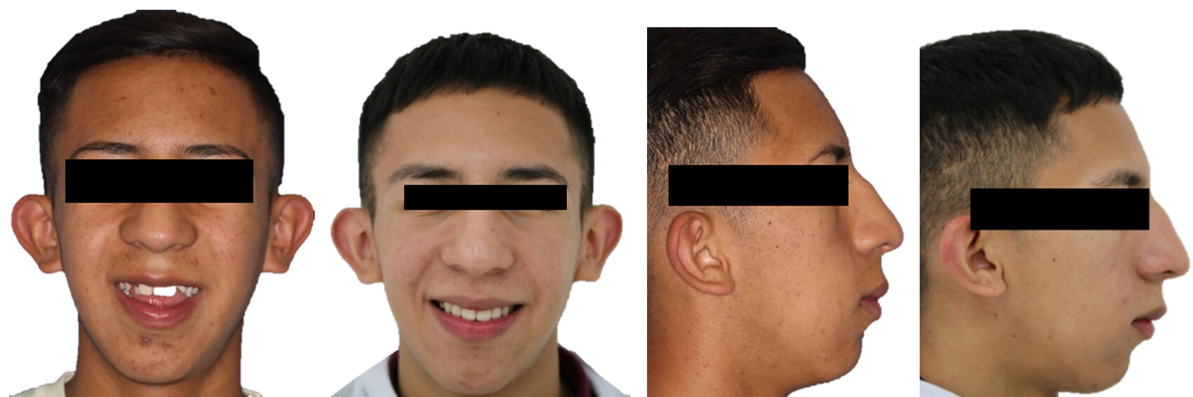 Fig.8 Extraorales frente sonrisa, perfil, comparación inicio final