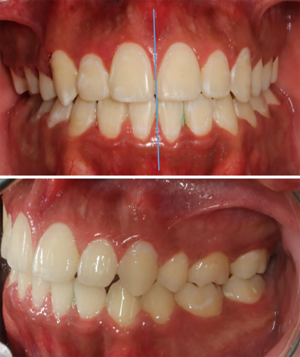 Fig.9 Intraoral frente y lateral izquierda final
