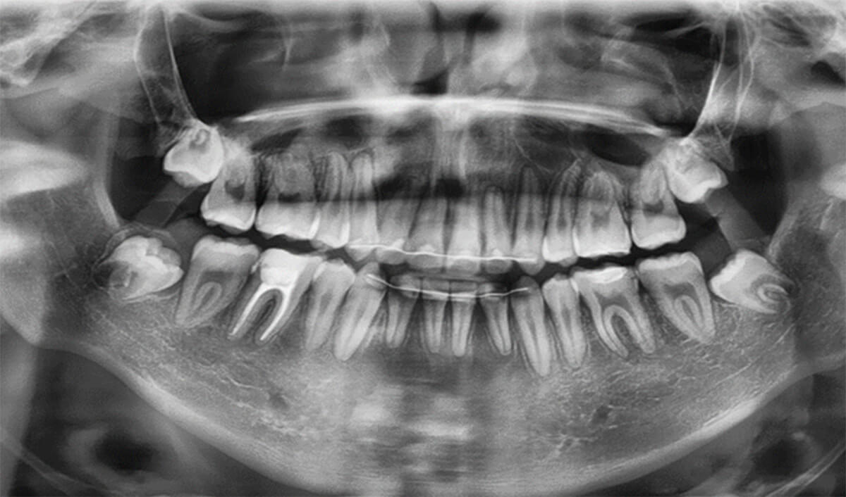 Fig.11 Radiografía panorámica final