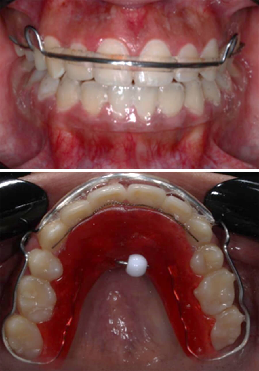 Fig.12 Intraoral de frente con retenedores