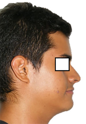 Fig. 2 Perfil recto