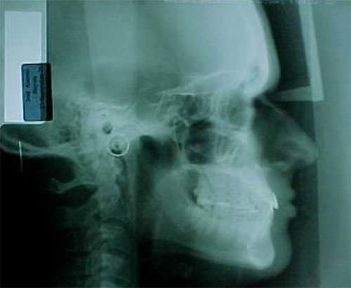 Fig. 6 Radiografía lateral de Cráneo inicial