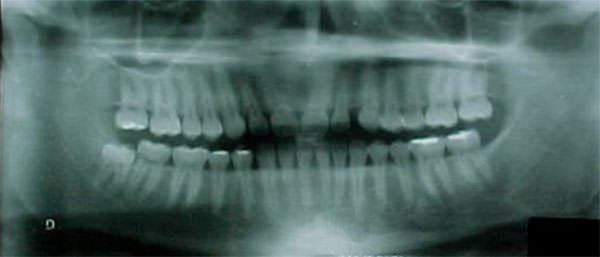 Fig. 7 Rx. panorámica inicial