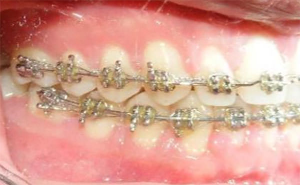 Fig. 9 Intraoral derecho