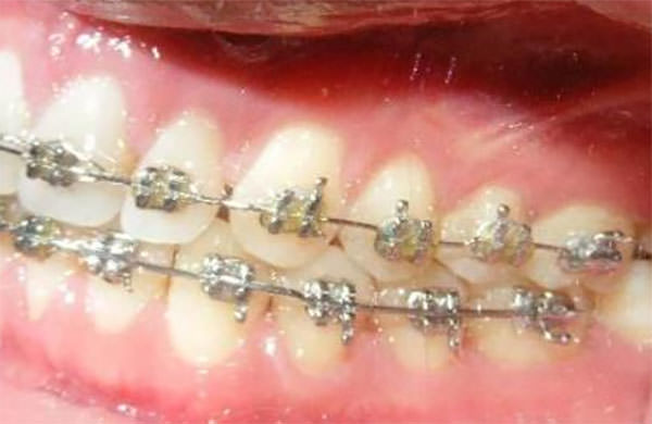 Fig. 10 Intraoral izquierda