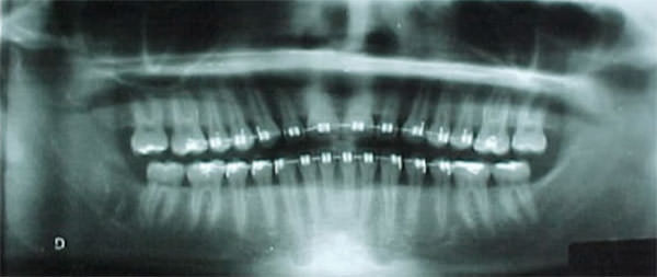 Fig. 11 Radiografía Panorámica