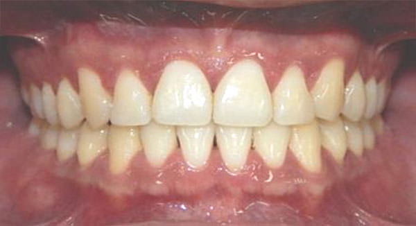 Fig. 15 Sonrisa