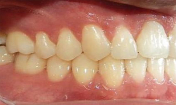 Fig. 16 Intraoral derecha