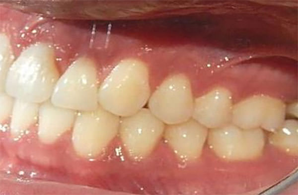 Fig. 17 Intraoral izquierda
