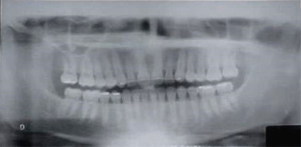 Fig. 18 Rx. panorámica final