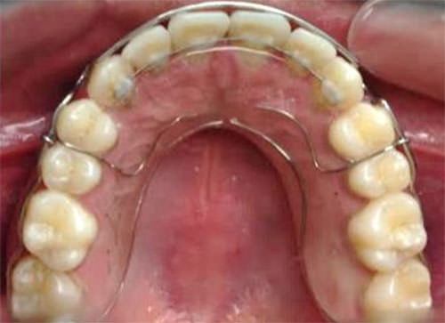 Fig. 19 Retenedor fijo y circunferencial Superior