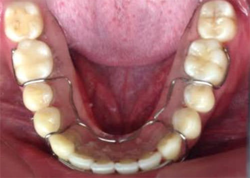 Fig. 20 Hawley Inferior