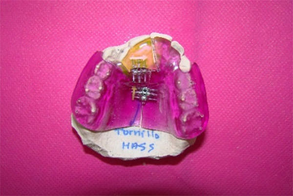 Figura 5 Bite Block