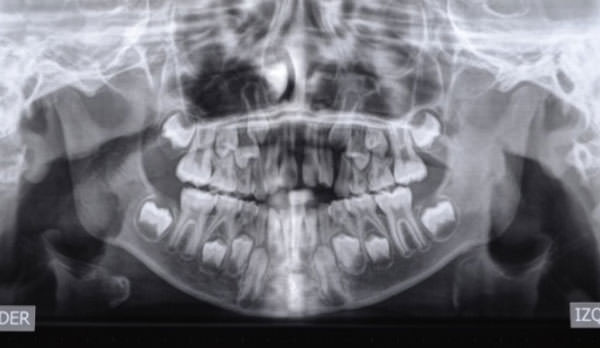 Figura 4 Radiografía Panorámica Inicial