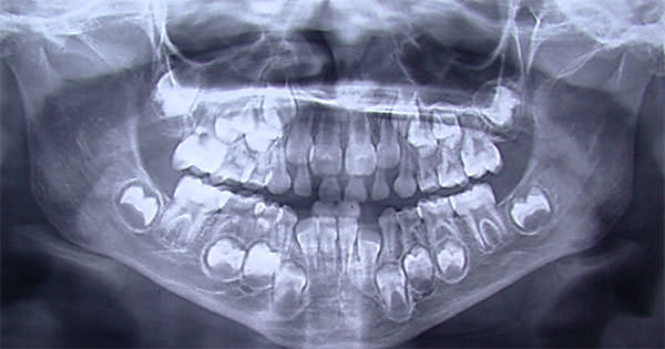 Figura 3 Radiografía Panorámica