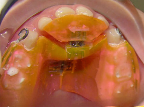 Figura 4 Bite Block cementado con tornillos sagital, transversal y ganchos para tracción extraoral.