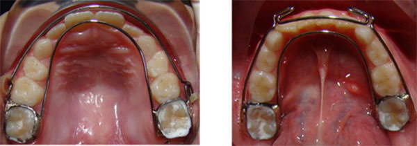Figura 9 Fase III Contención y estabilización dentomaxilar