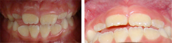 Figura 10 Resultado después del pico de crecimiento mandibular