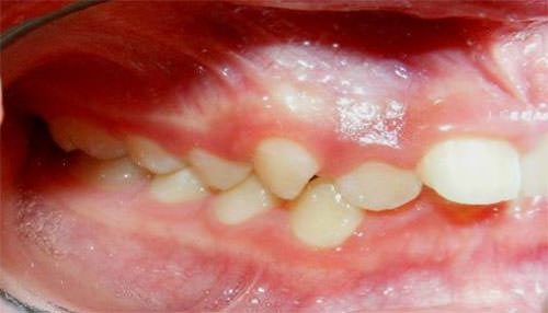 Fig. 3 Intraoral lateral derecha