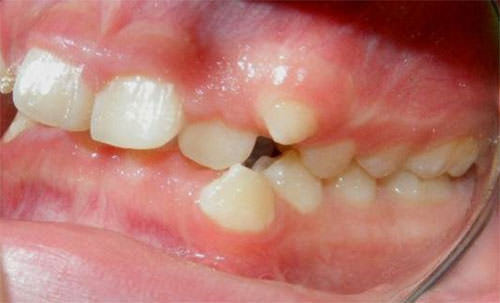 Fig. 4 Intraoral izquierda