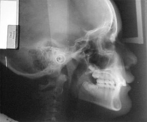 Figura 9 Radiografia lateral de craneo