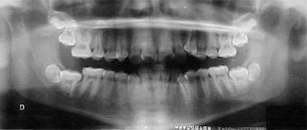 Figura 10 Radiografía panorámica