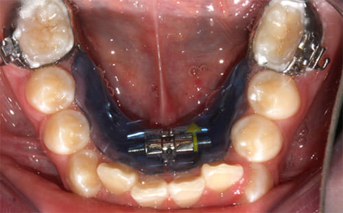 Fig. 13 Expansion mandibular de inicio con Schwartz