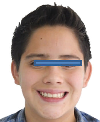 Fig. 16 Sonrisa
